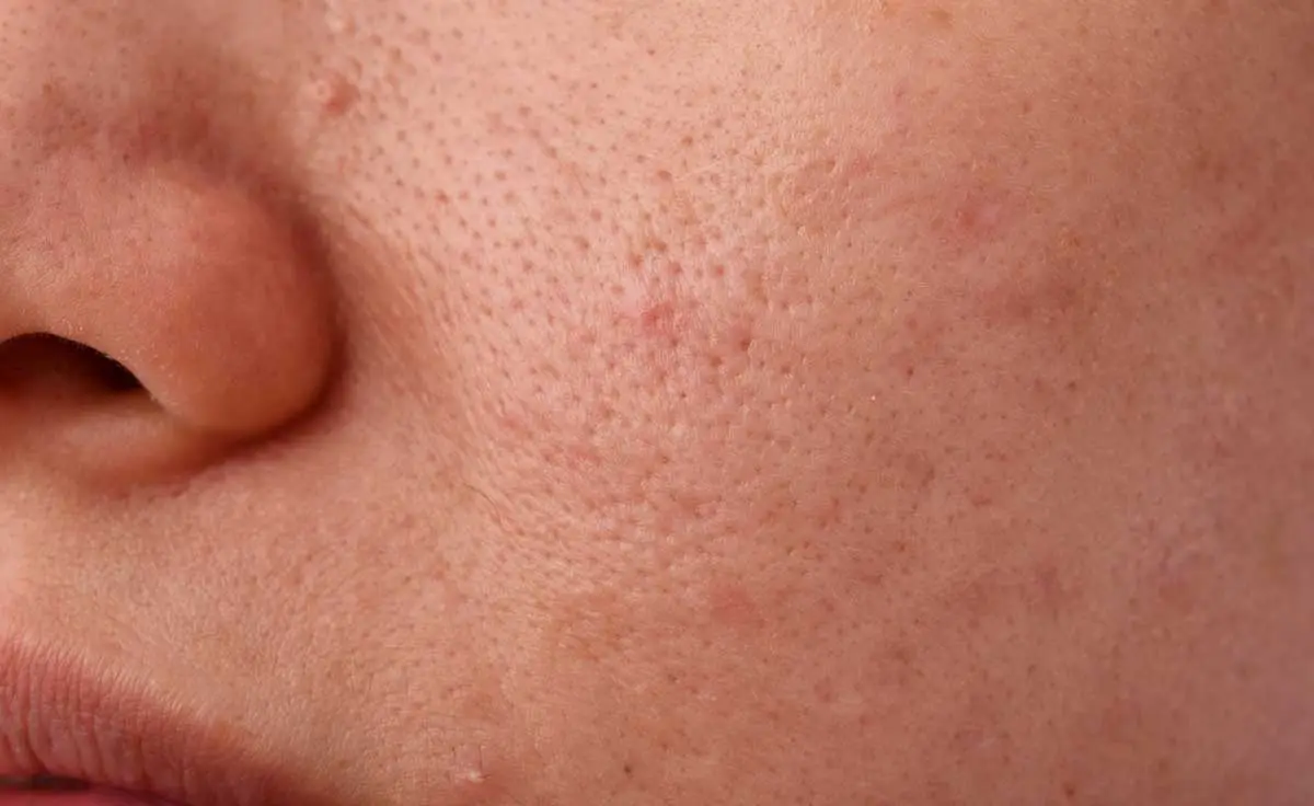 رابطه پودر فیکساتور با ایجاد جوش و آکنه
